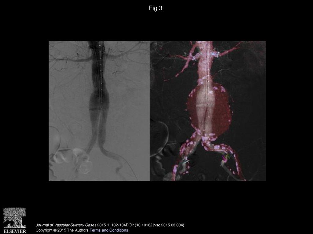 Urgent Endovascular Repair For Ruptured Aortic Aneurysm Using Computed